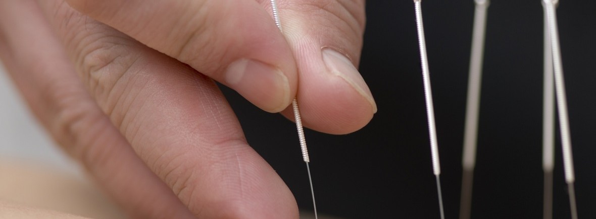 what is acupuncture